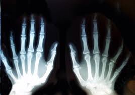 6 fingers.jpg