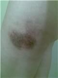 bruise.jpg