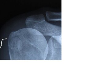12 An undisplaced fracture of the humoral head.jpg