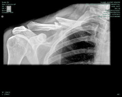 CollarBone29thNovember.jpg
