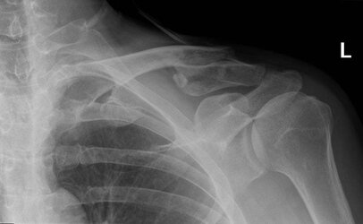 Collar bone 6 weeks cropped and resized.jpg