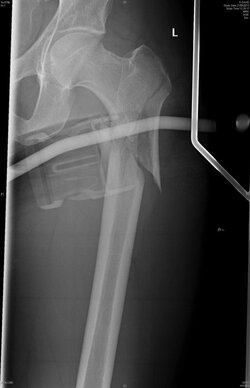 femur proximal fracture .jpg