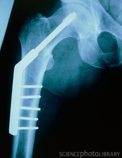 M3300143-X-ray_of_a_pinned_human_hip-SPL.jpg