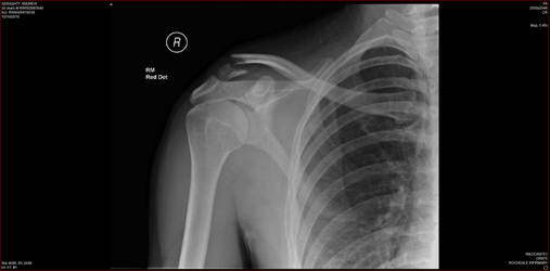 Collar bone.png