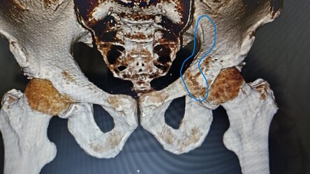Pelvis2.jpg