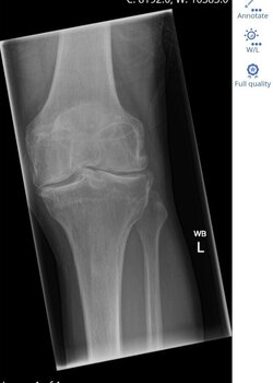 left xray1 (1) (2).jpg left xray1 (1) (2).jpg