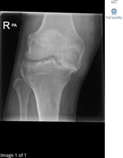 right xray 1 (1).jpg right xray 1 (1).jpg