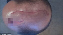 Ben  head wound scar.jpg