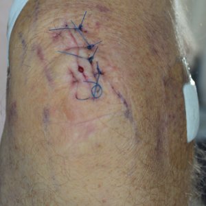 Elbow stitches