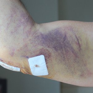 Elbow bruise post op