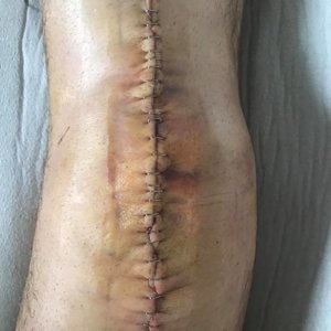 28 staples