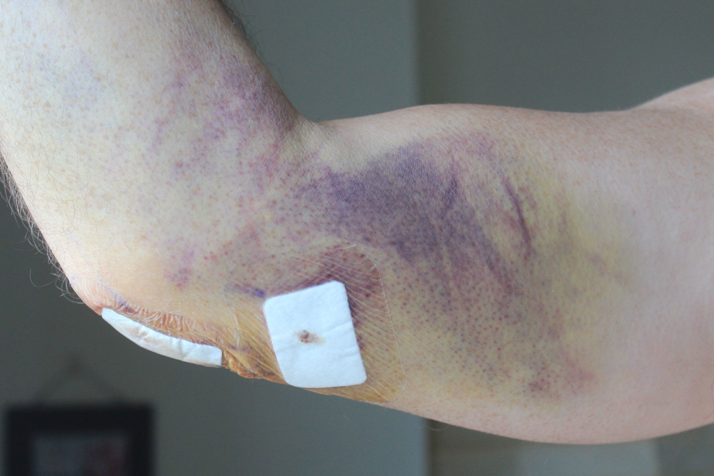 Elbow bruise post op